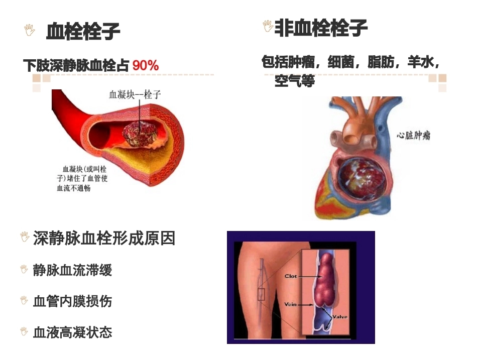 肺栓塞业务学习_第5页