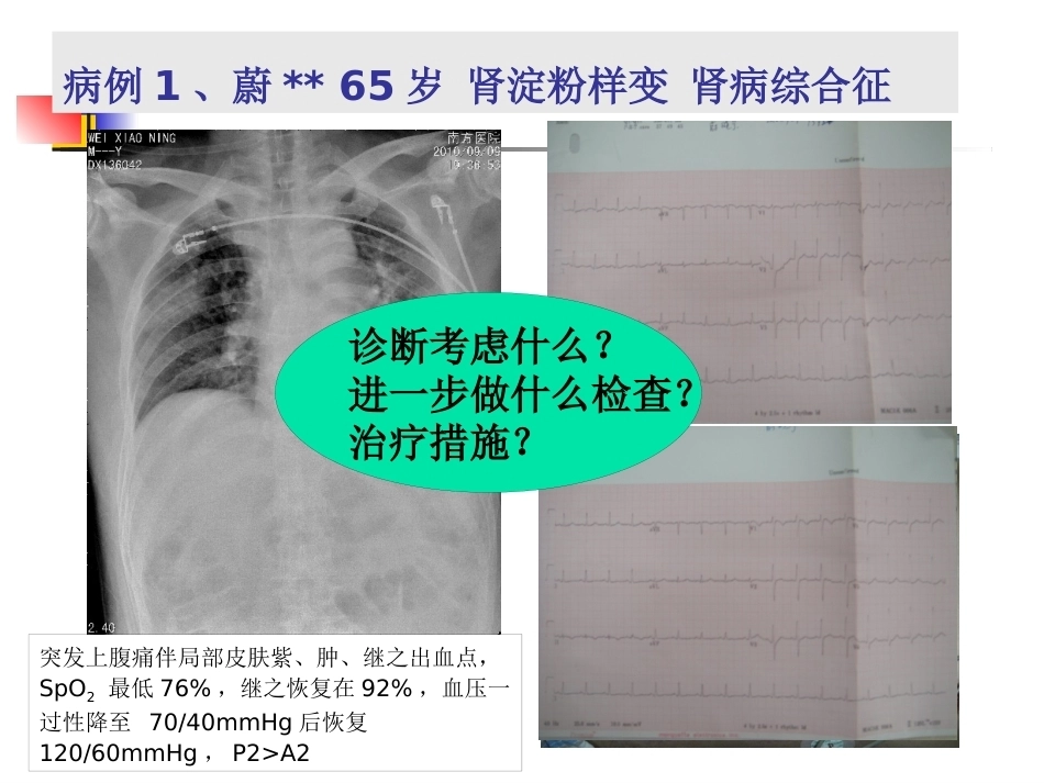 肺栓塞(本科讲义)_第2页