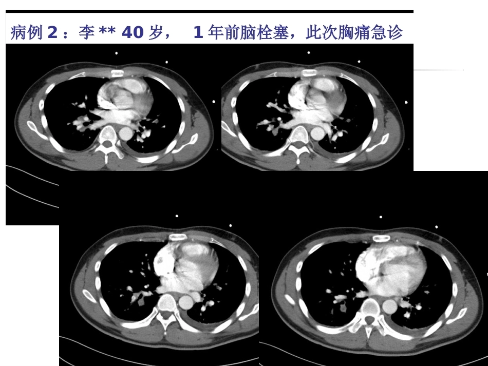 肺栓塞(本科讲义)_第3页