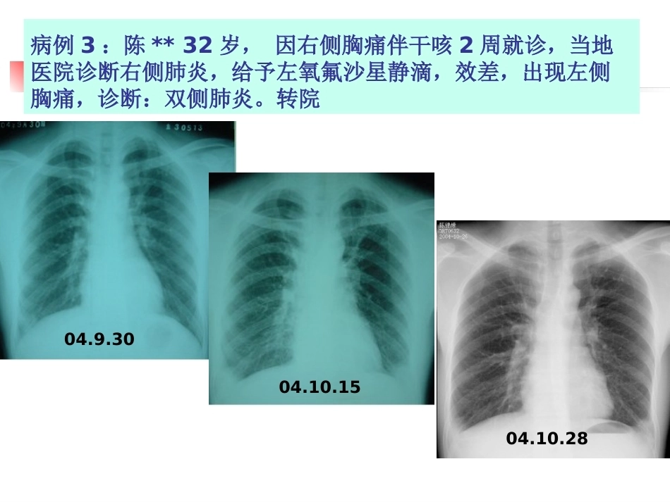 肺栓塞(本科讲义)_第4页