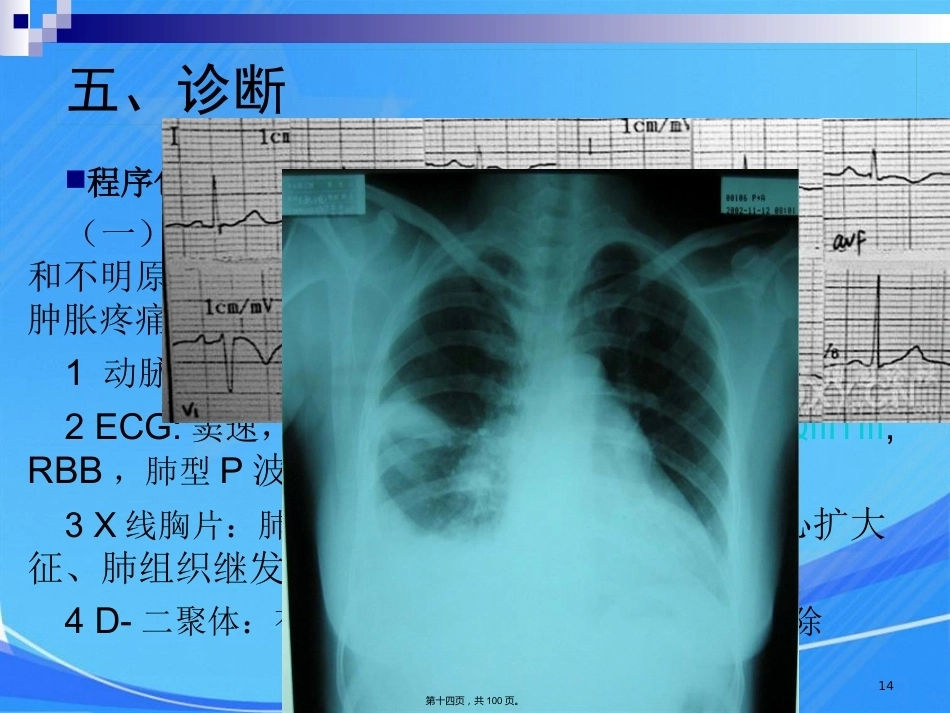 肺栓塞肺动脉高压与慢性肺源性心脏病_第14页