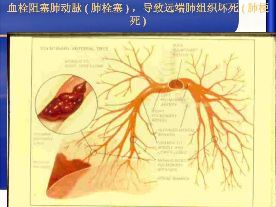 肺栓塞 (1)_第13页
