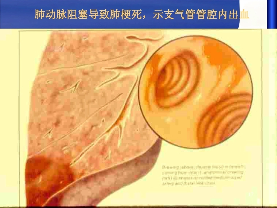 肺栓塞 (1)_第14页