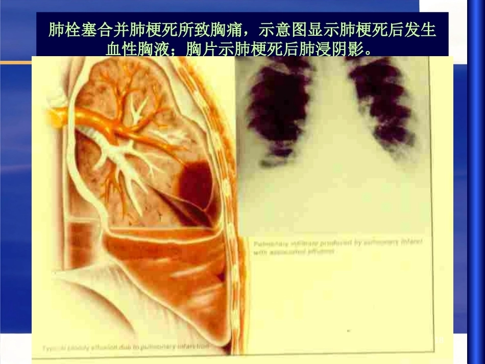 肺栓塞 (1)_第15页