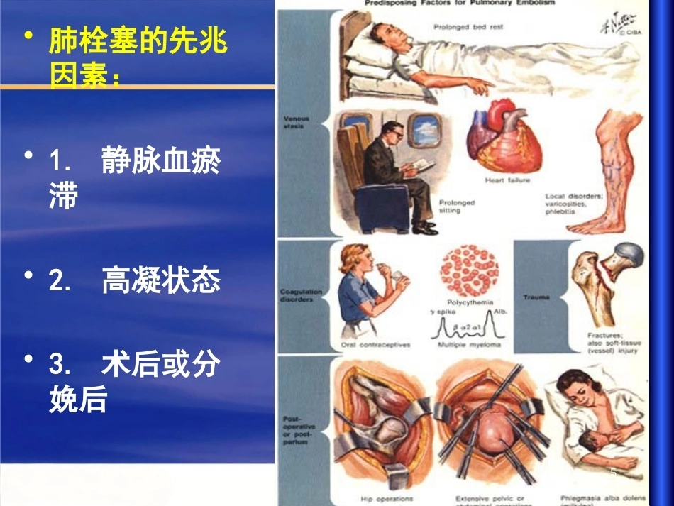 肺栓塞 (1)_第5页