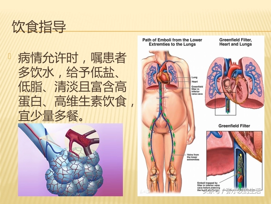 肺栓塞(4)_第14页