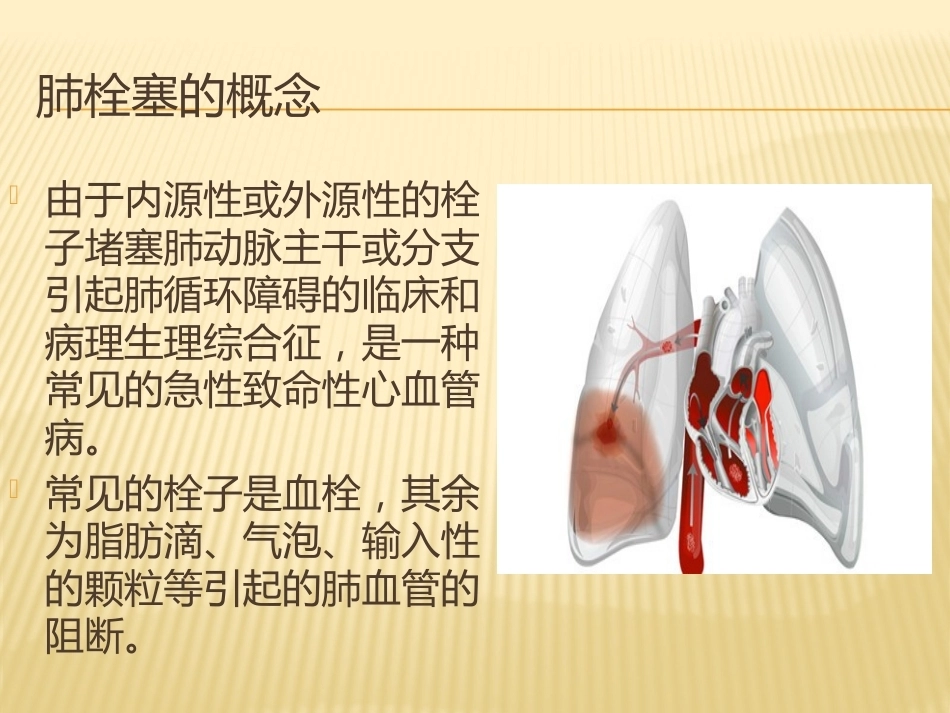 肺栓塞(4)_第2页