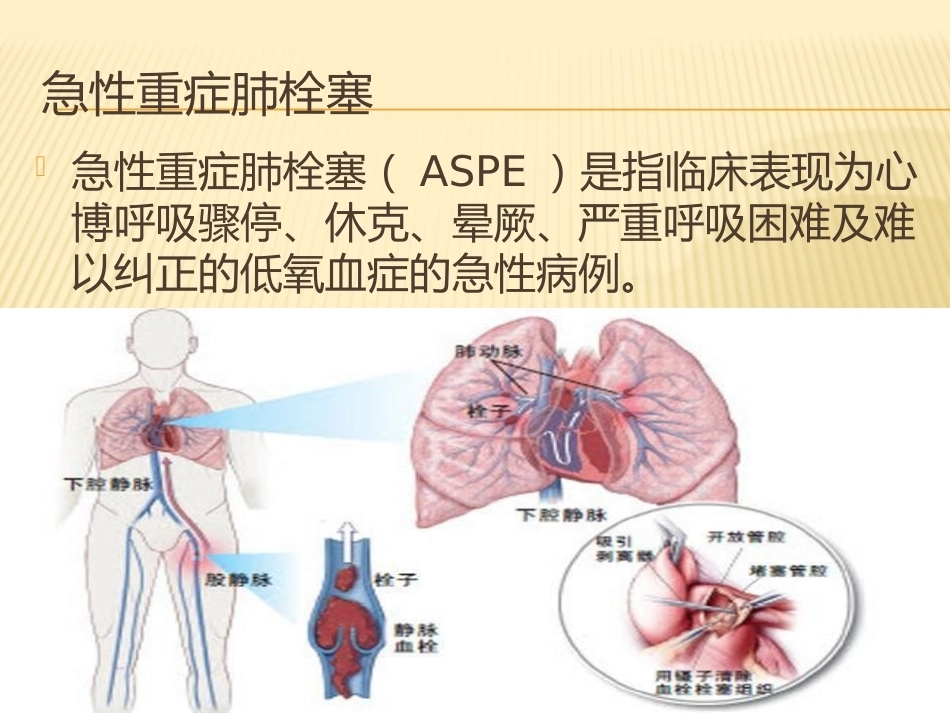 肺栓塞(4)_第4页
