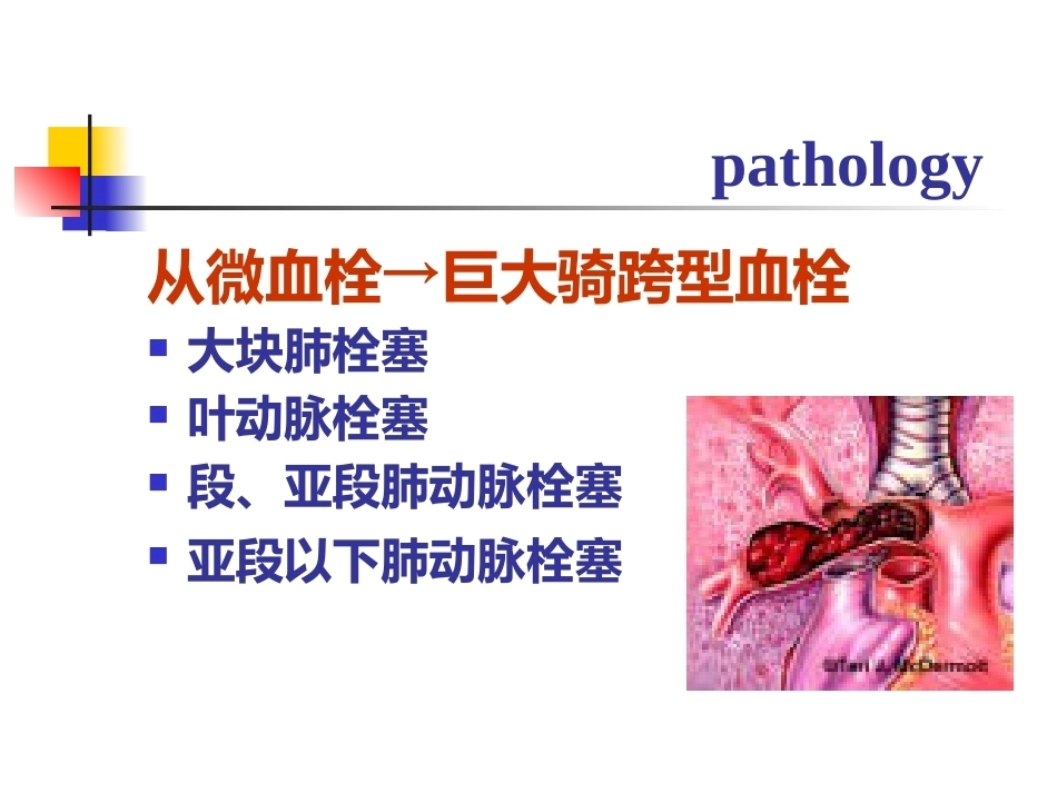 肺栓塞的诊断与治疗 PPT(5)_第12页