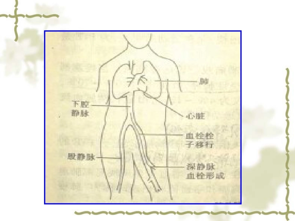 肺栓塞(5)_第5页
