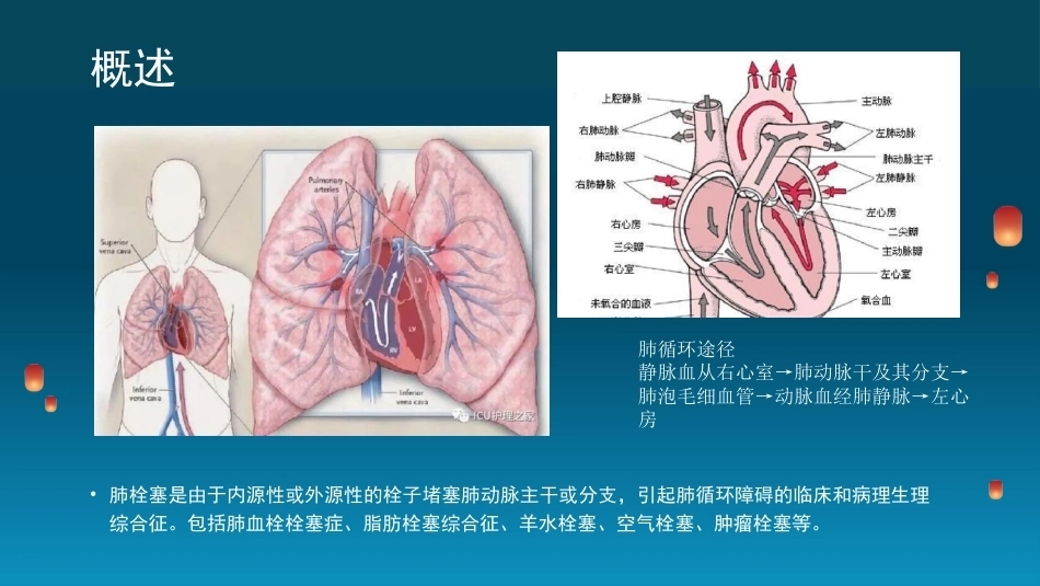 肺栓塞(6)_第2页