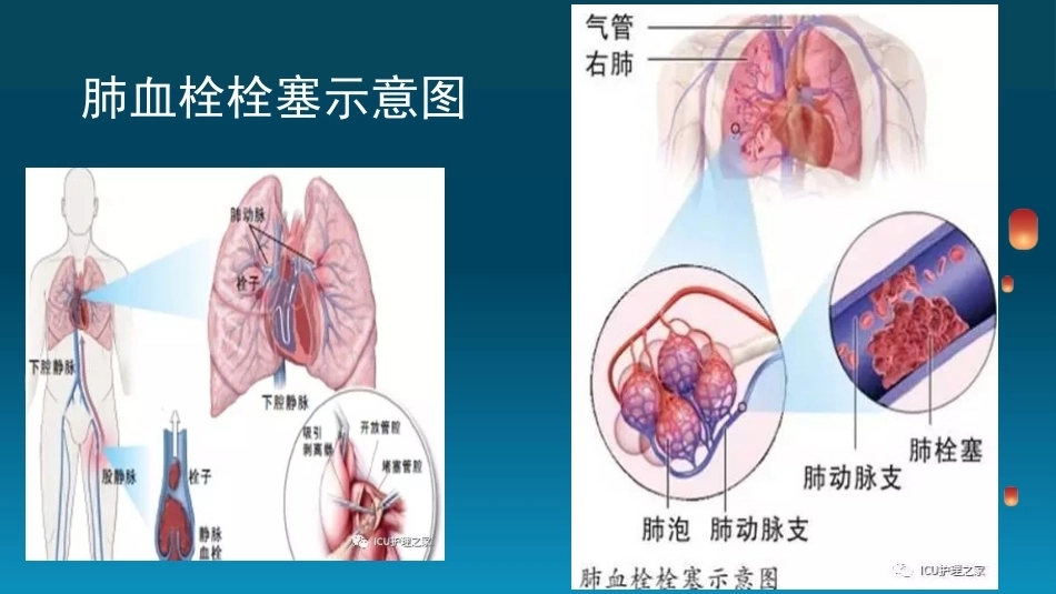 肺栓塞(6)_第4页