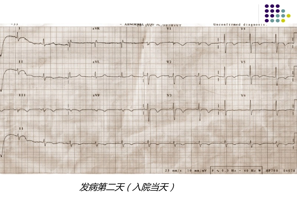 肺栓塞诊治7_第15页