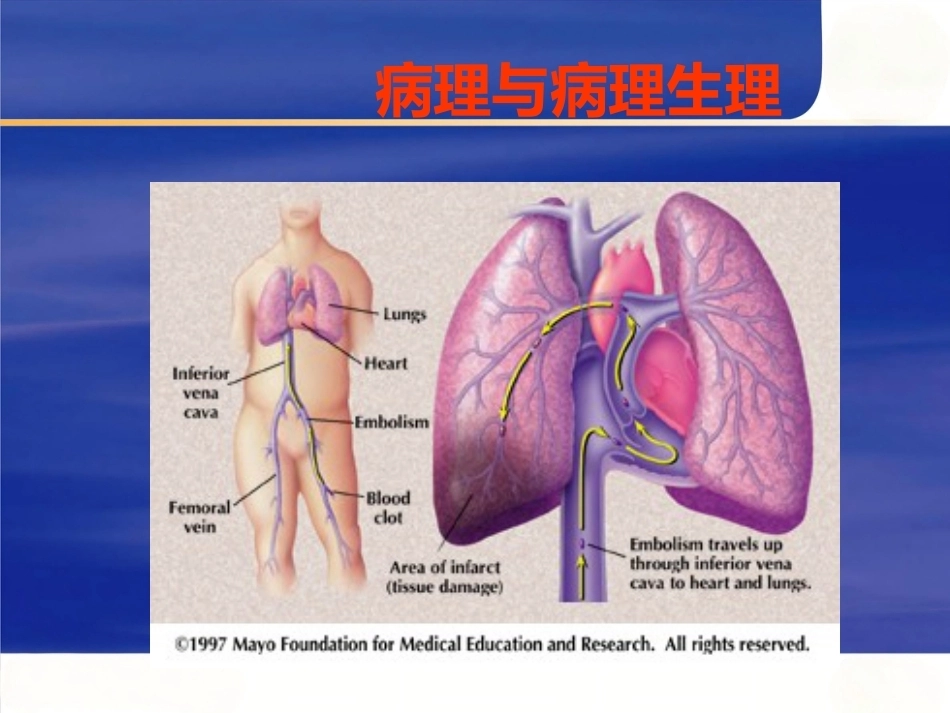 肺栓塞的诊断与治疗 PPT(8)_第6页