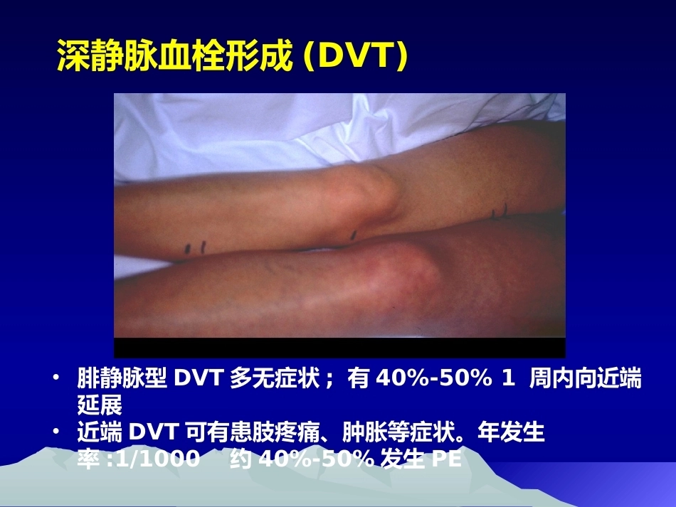 肺栓塞(12)_第8页