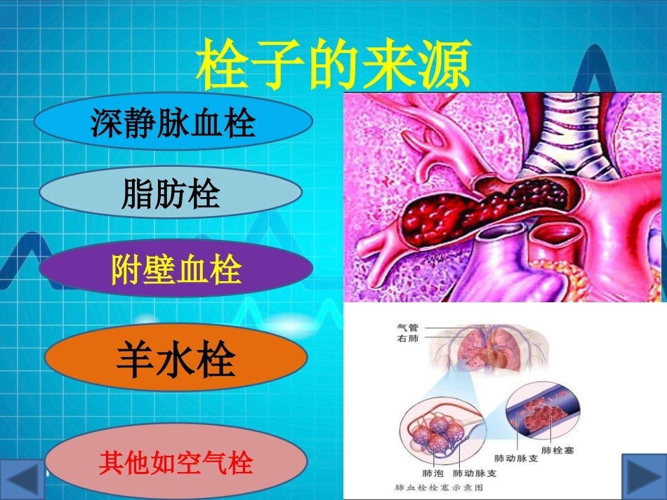 肺栓塞(13)_第4页