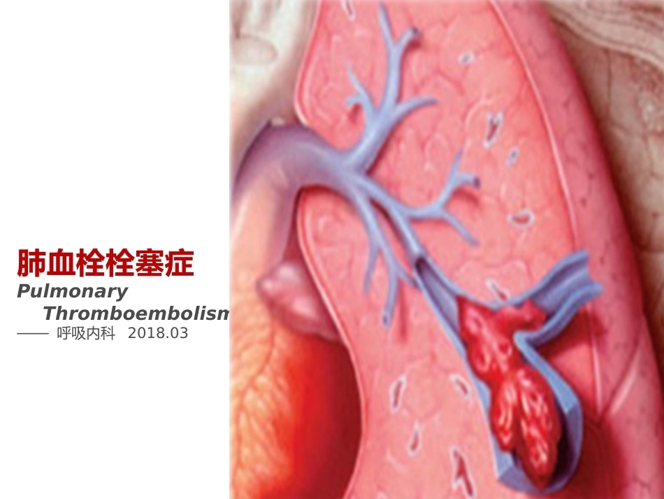 肺栓塞(14)_第1页