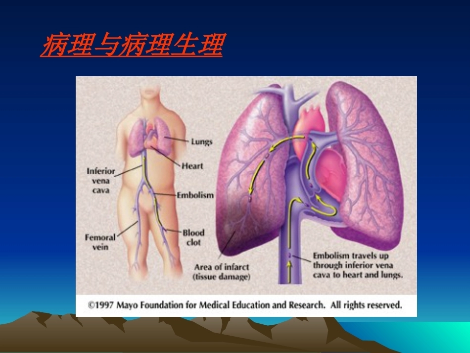 肺栓塞(16)_第5页