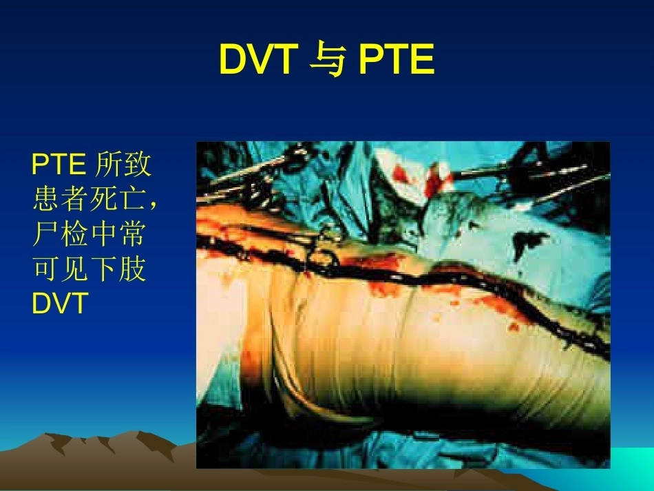 肺栓塞(16)_第7页