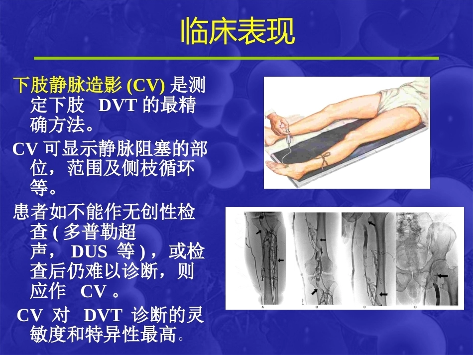 肺栓塞(19)_第11页