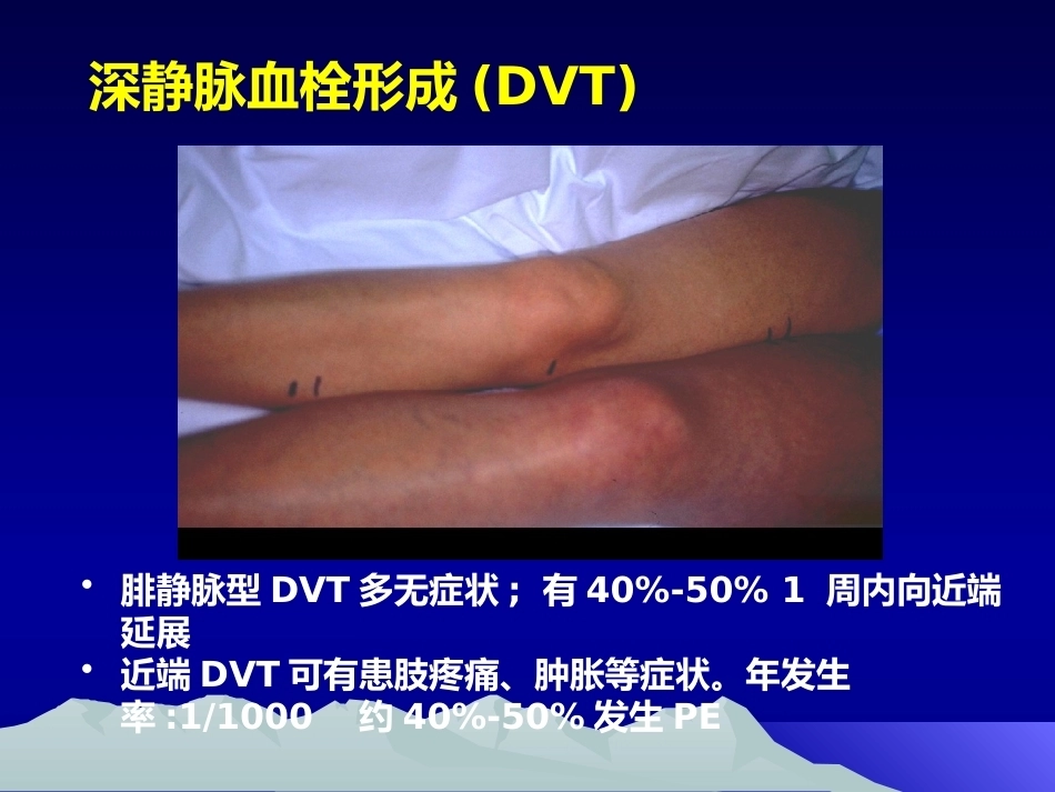 肺栓塞(20)_第11页