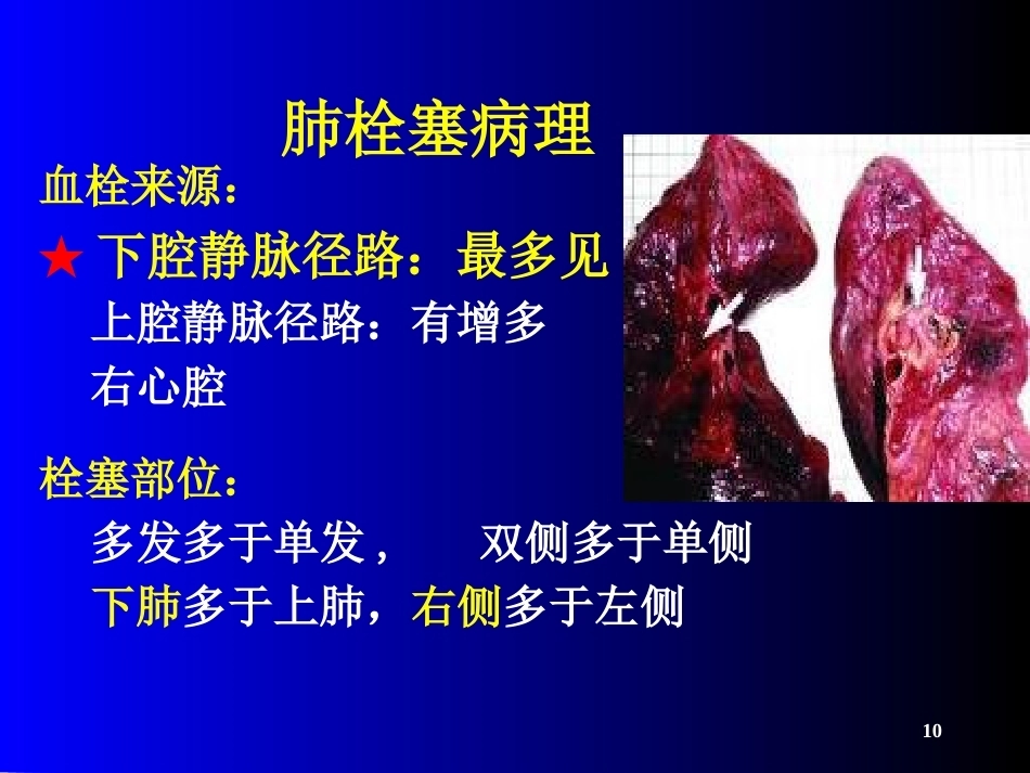肺栓塞(21)_第10页