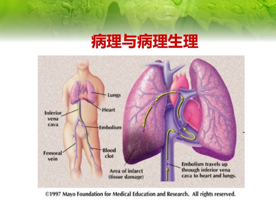 肺栓塞(23)_第9页
