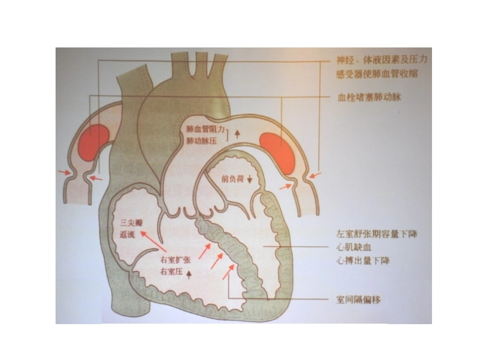 肺栓塞(24)_第11页
