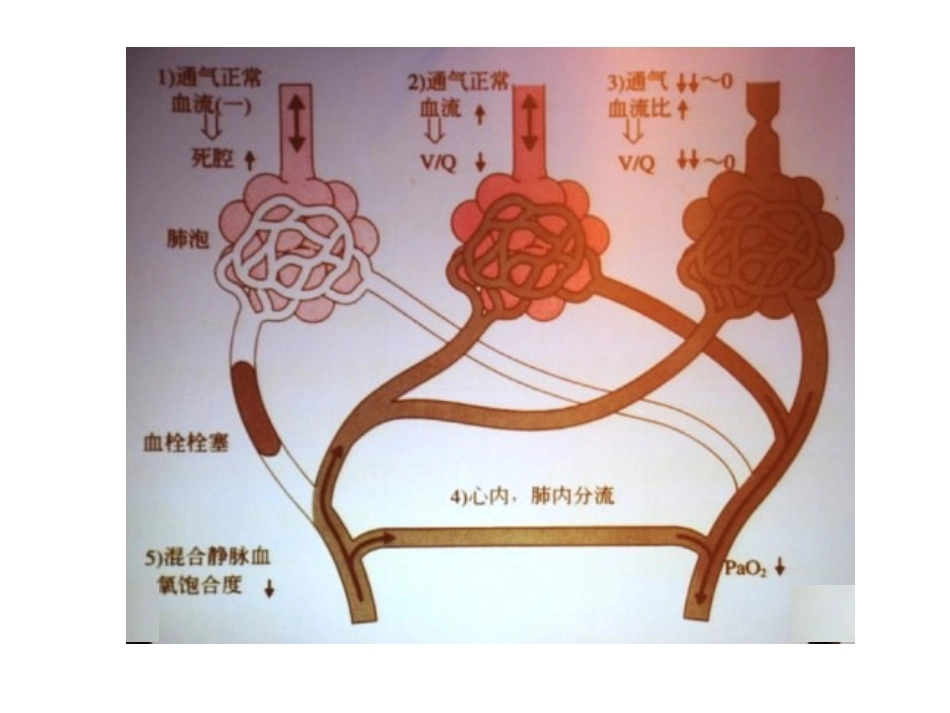 肺栓塞(24)_第12页