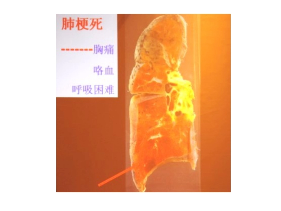 肺栓塞(24)_第13页