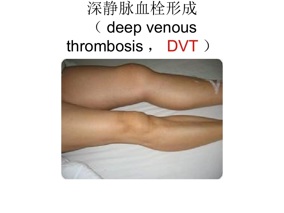 肺栓塞(24)_第6页