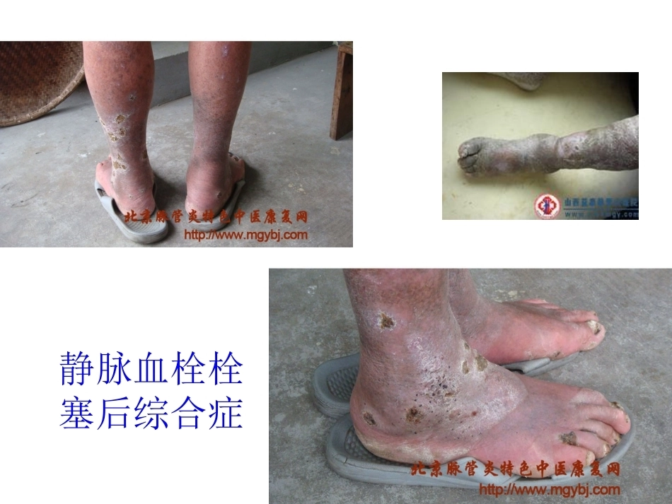 肺栓塞(24)_第7页