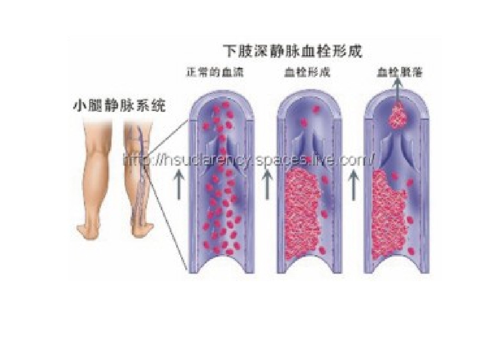 肺栓塞(24)_第8页