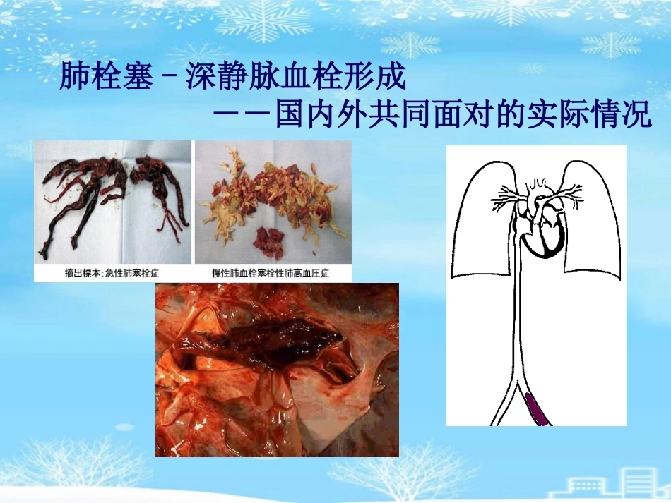 肺栓塞(27)_第11页