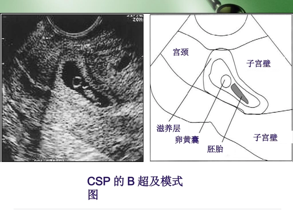 剖宫产子宫瘢痕妊娠_第15页