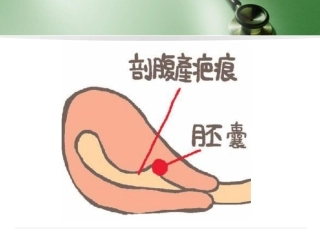 剖宫产子宫瘢痕妊娠