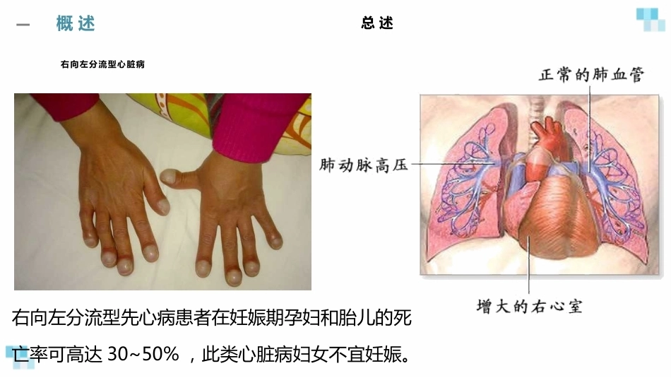 妊娠合并心脏病经典课件_第12页