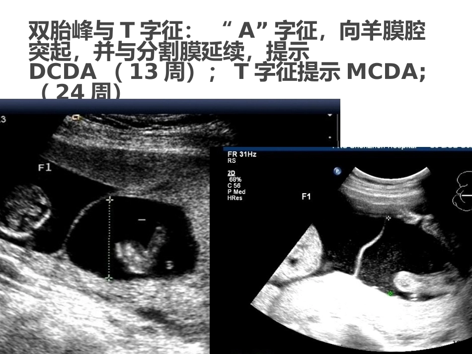 双胎妊娠的早孕期超声诊断PPT课件_第10页