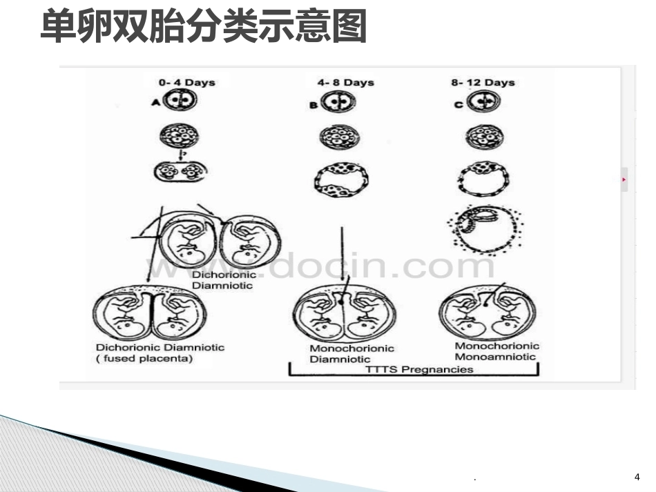双胎妊娠的早孕期超声诊断PPT课件_第4页