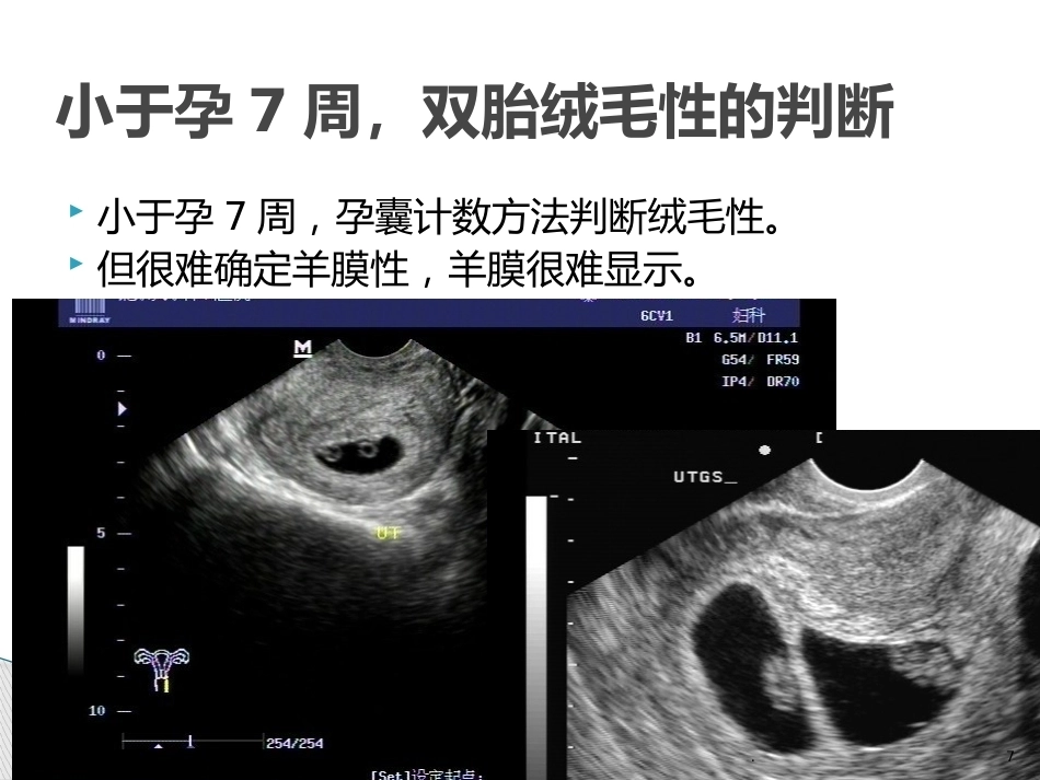 双胎妊娠的早孕期超声诊断PPT课件_第7页