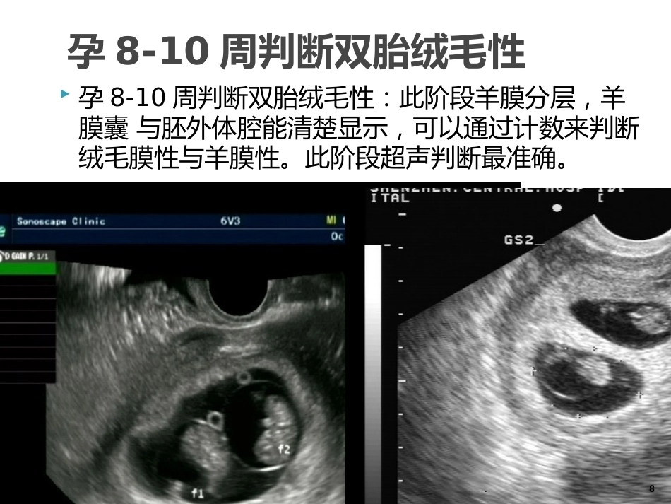 双胎妊娠的早孕期超声诊断PPT课件_第8页