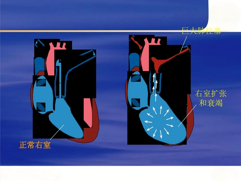 围术期肺栓塞的处理及预防_第9页