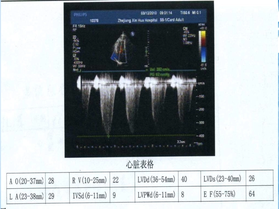 误诊为急性冠脉综合征的肺栓塞分析_第11页