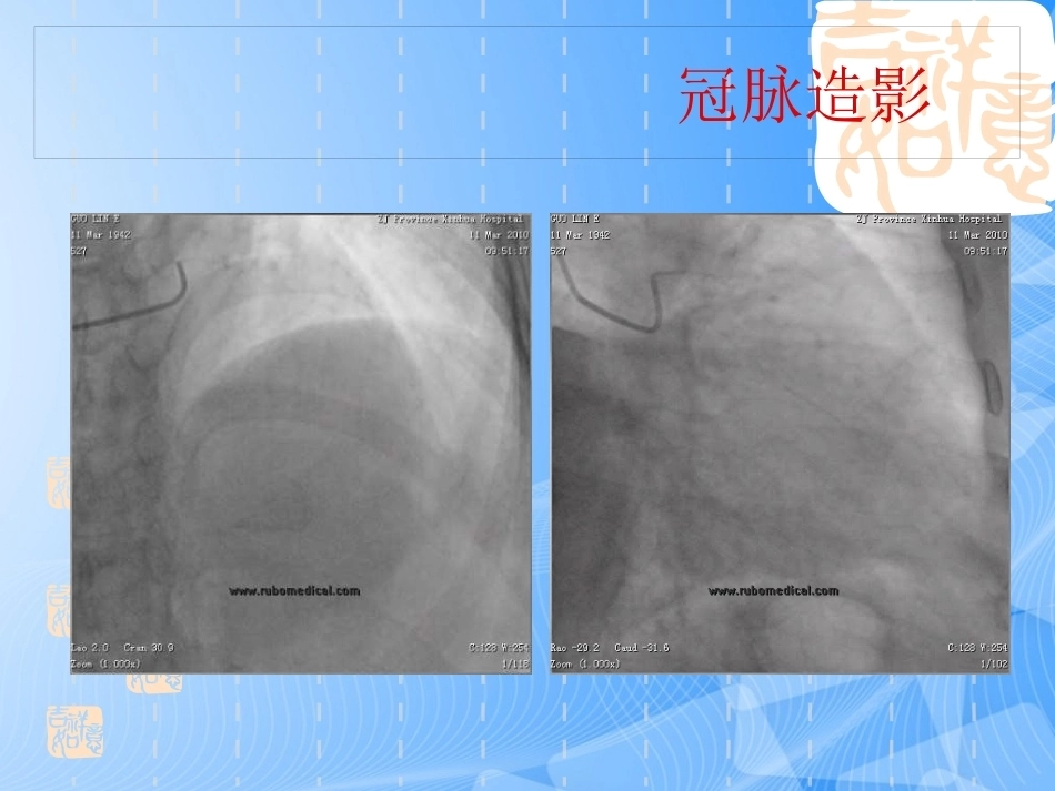 误诊为急性冠脉综合征的肺栓塞分析_第13页