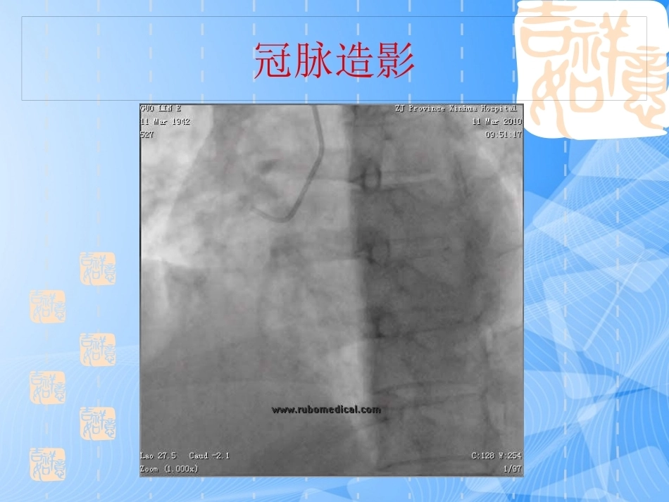 误诊为急性冠脉综合征的肺栓塞分析_第14页