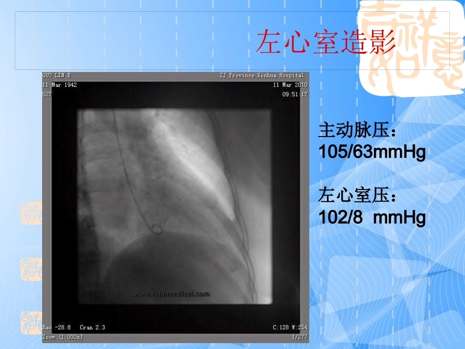 误诊为急性冠脉综合征的肺栓塞分析_第15页
