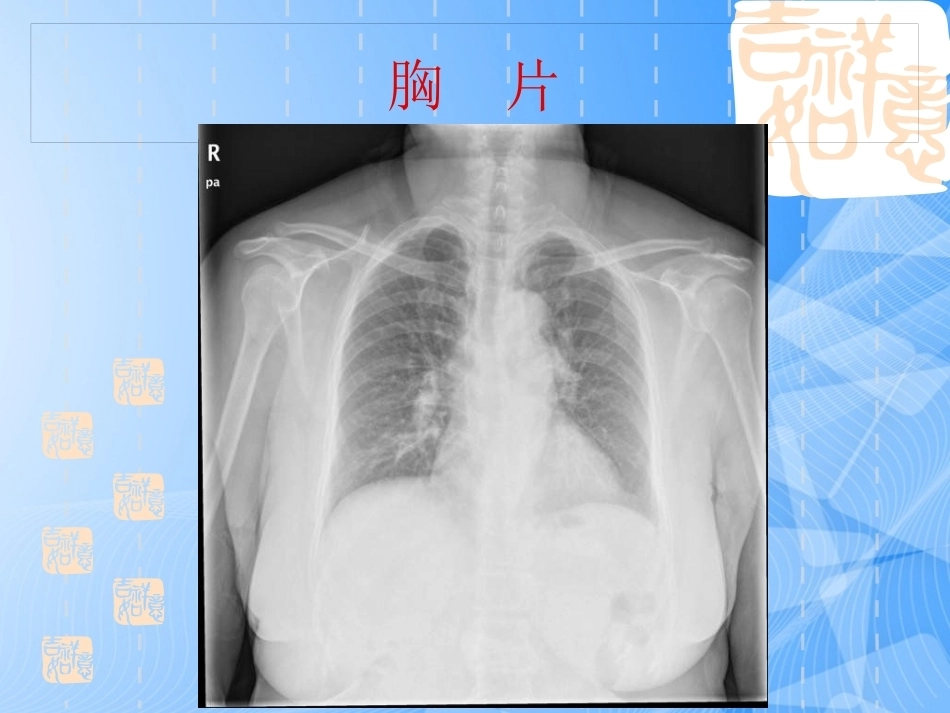 误诊为急性冠脉综合征的肺栓塞分析_第7页