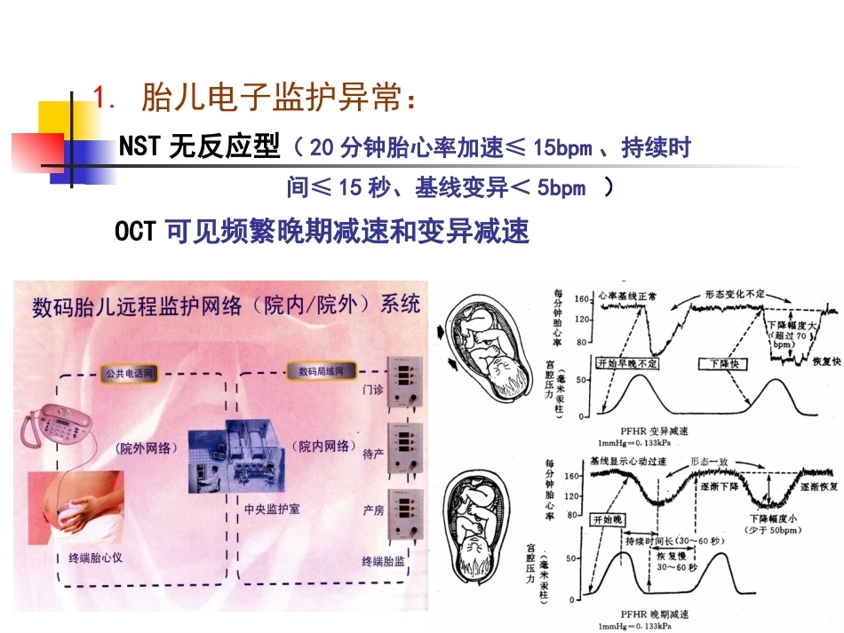 胎儿宫内窘迫_第15页