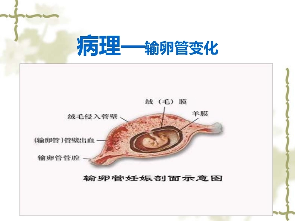 输卵管妊娠中以壶腹部妊娠最多_第10页