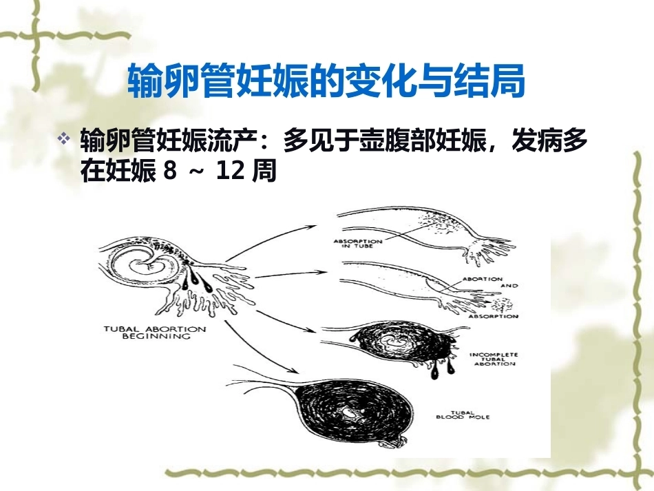 输卵管妊娠中以壶腹部妊娠最多_第11页